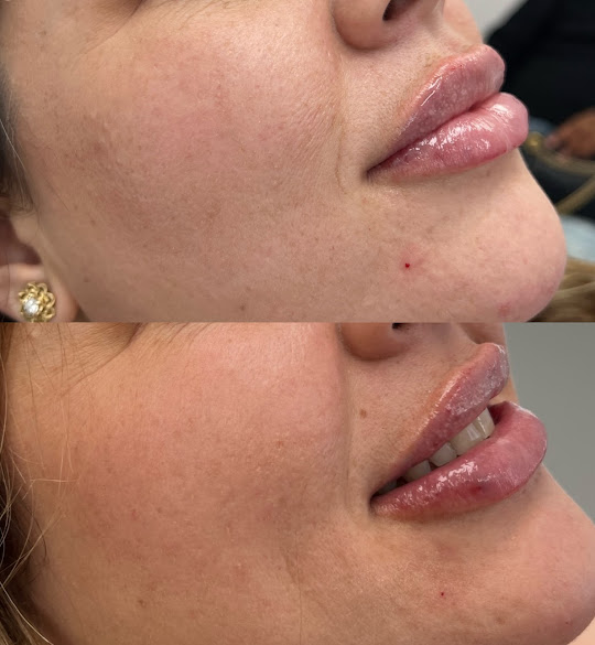 Lip augmentation butt treatments in Central Alameda thumbnail