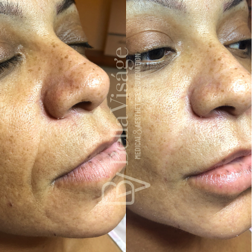 Explore groot tattoo ideas, creative tattoo ideas in Lakeland, available at Bella Visge Medical & Aesthetic Rejuvenation