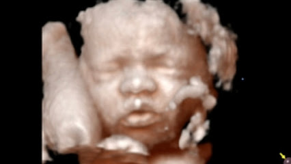 Early Images 3d 4d ultrasound
