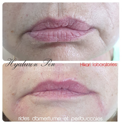 Microneedling Cannes. Beauty Solution by Sarah à Cannes