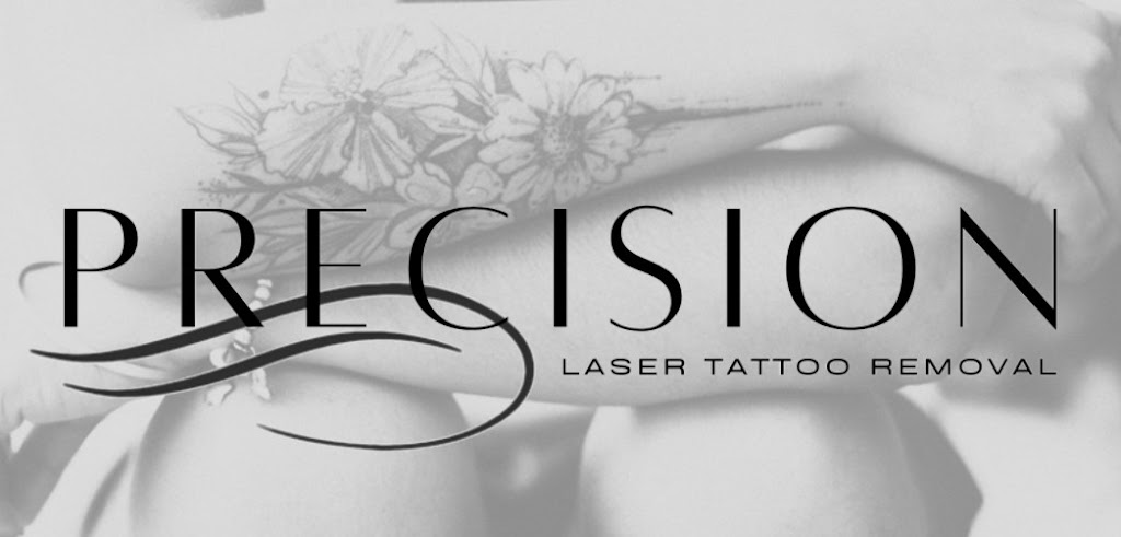 Precision Laser Tattoo Removal 34638