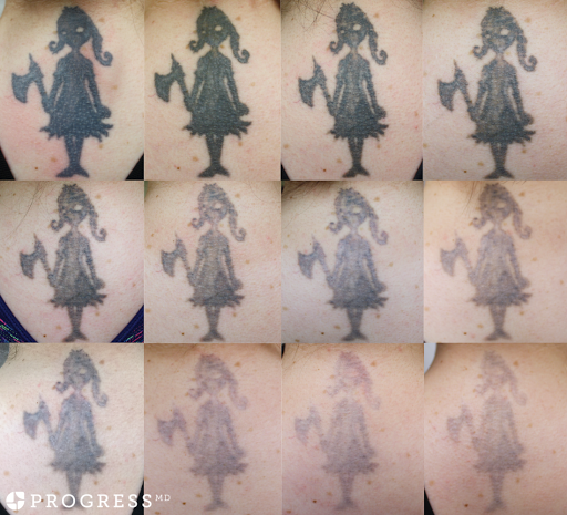 Explore tattoo ideas eyes, creative tattoo ideas in Amarillo, available at Progress MD Tattoo Removal