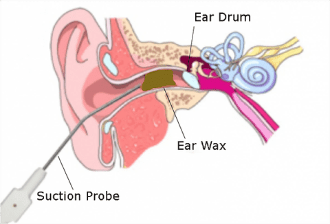 Comments and reviews of Ear Wax Removal NHS Accredited