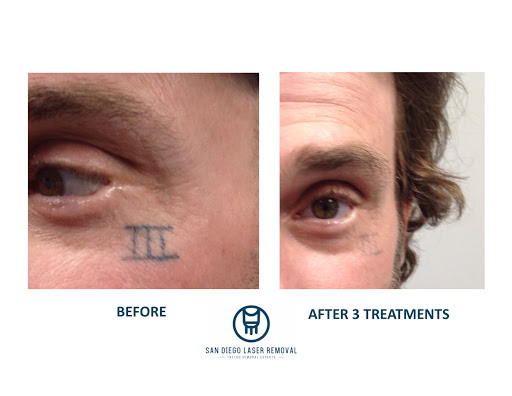 Explore baymax tattoo ideas, creative tattoo ideas in San Diego, available at Removery Tattoo Removal & Fading