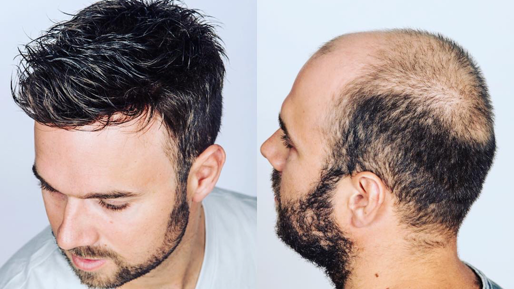 Man Hair - Hair Replacement Solutions 32003