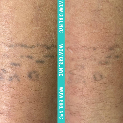 Explore tattoo ideas simple, creative tattoo ideas in New York, available at WOW LASER NYC Tattoo removal in New York