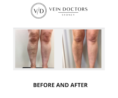 Vein Doctors Sydney - Varicose Vein Treatment Specialists