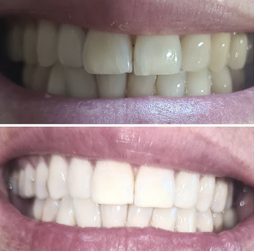 RemaBeauty - Extension de Cil - Injection hyaluronique (HaluronPen) - Blanchiment Dentaire