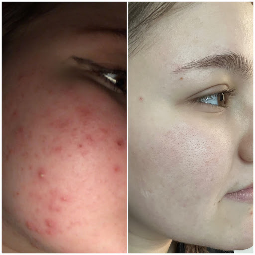 Explore tattoo ideas collarbone, creative tattoo ideas in Tucson, available at Allure Medical