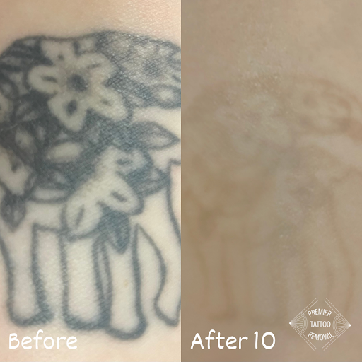 Explore beautifully broken tattoo ideas, creative tattoo ideas in Mckinney, available at Premier Tattoo Removal