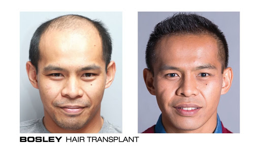 Hair Transplantation Clinic «Bosley Medical - Atlanta», reviews and photos, 3379 Peachtree Rd NE #800, Atlanta, GA 30326, USA