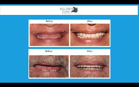 All On 4 Clinic Perth - All On 4 Clinic Perth