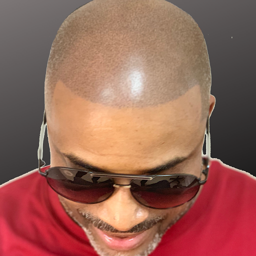 Scalp Micropigmentation • Hair Tattoo