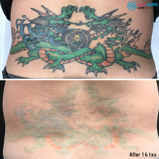 Explore nebraska tattoo ideas, creative tattoo ideas in Westminster, available at Newhope Laser Skin Care