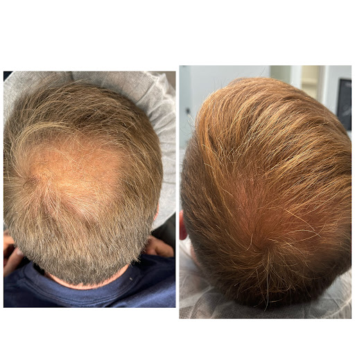 Explore never again tattoo ideas, creative tattoo ideas in Roseville, available at NuHair Ink. Scalp MicroPigmentation & Aesthetic Clinic of Sacramento