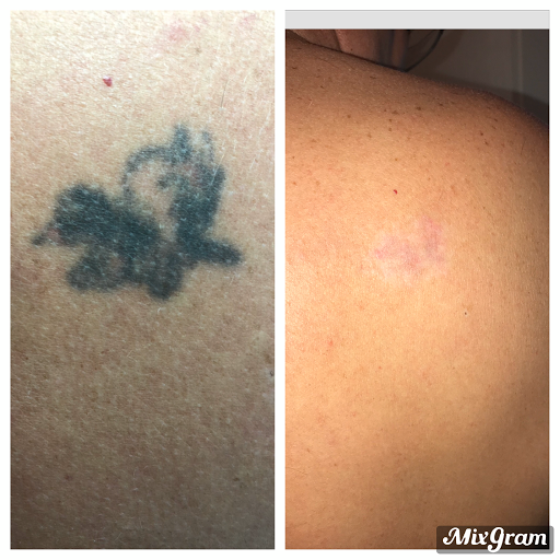 Explore phoenix tattoo ideas for men, creative tattoo ideas in Longview, available at Vanish Laser Aesthetics