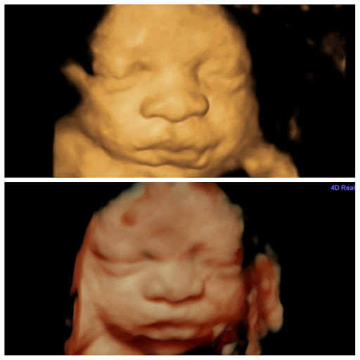 A Little Insight 3D 4D 5D Ultrasound image