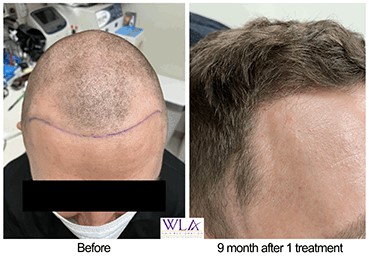 West LA Hair Restoration