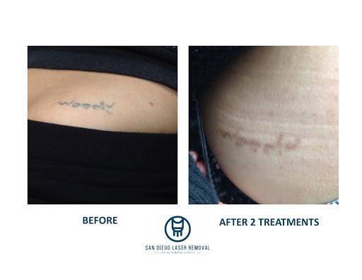 Find armband tattoo ideas for your next unique tattoo in San Diego at Removery Tattoo Removal & Fading