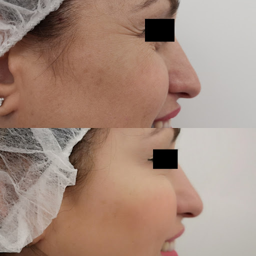 CLÍNICA BEDOYA - Ácido hialurónico, Eliminación de Verrugas, y Rejuvenecimiento Facial