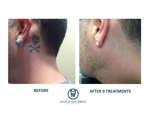 Explore tattoo ideas for adoption, creative tattoo ideas in San Diego, available at Removery Tattoo Removal & Fading