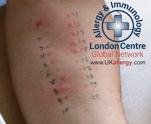 London Allergy and Immunology Centre - Harley Street Medical Centre - London Allergy and Immunology Centre - Harley Street Medical Centre