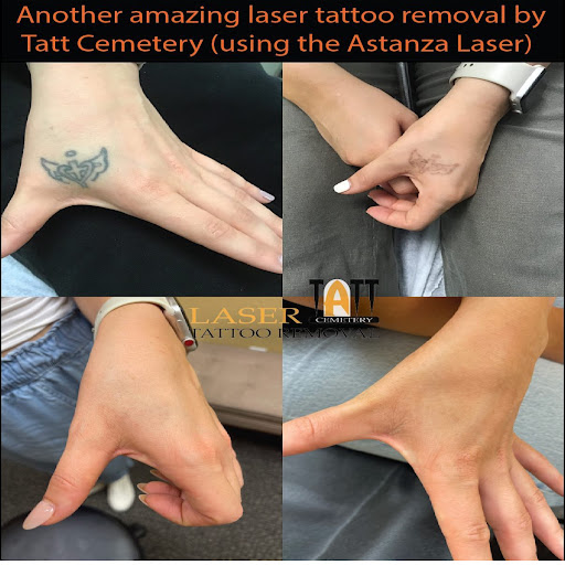 Explore calf muscle tattoo ideas, creative tattoo ideas in Fort Myers, available at Laser Tattoo Removal by Tatt Cemetery