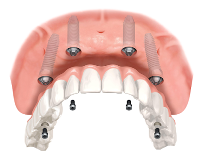 Gus Koroneos Denture & Implant Solutions