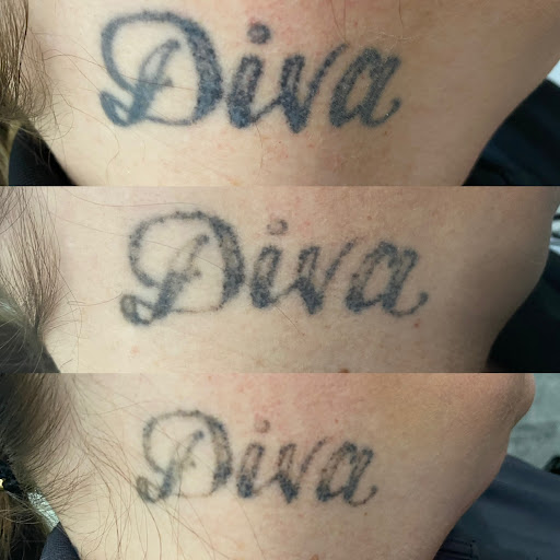 Explore small gap filler tattoo ideas, creative tattoo ideas in Lake Jackson, available at Second Chance Laser Tattoo Removal