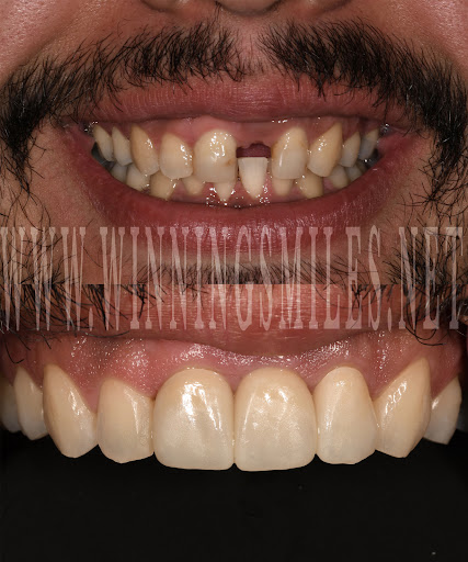 Teeth whitening service Fontana
