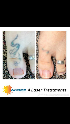 Explore broly tattoo ideas, creative tattoo ideas in Port Charlotte, available at Envision Laser Removal