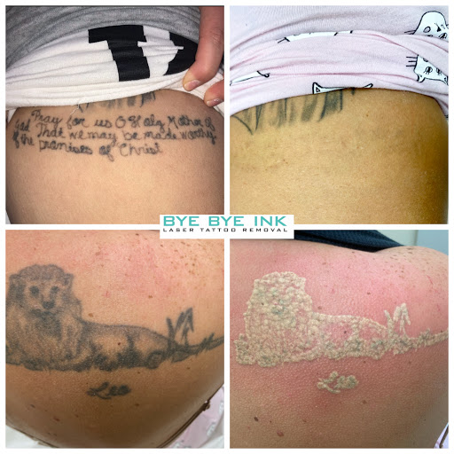 Explore nyc tattoo ideas, creative tattoo ideas in Middle Village, available at Bye Bye Ink Laser Tattoo Removal