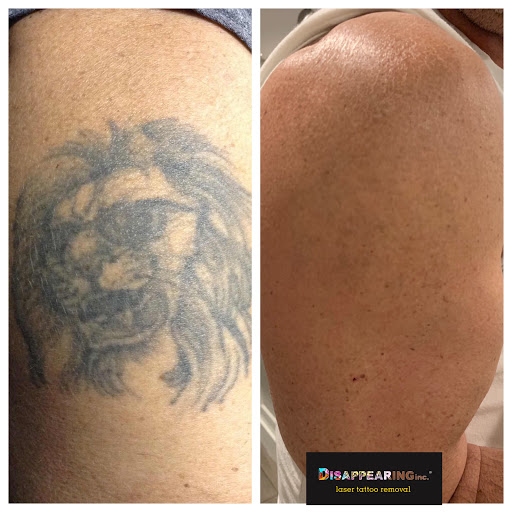 Explore stay wild tattoo ideas, creative tattoo ideas in Lawrence, available at Removery Tattoo Removal & Fading