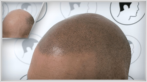 Haarpigmentierung | Modern Hair Loss Solution