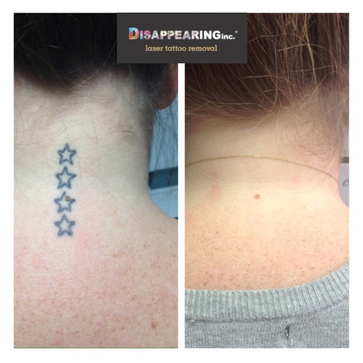 Explore puerto rican tattoo ideas, creative tattoo ideas in Lawrence, available at Removery Tattoo Removal & Fading