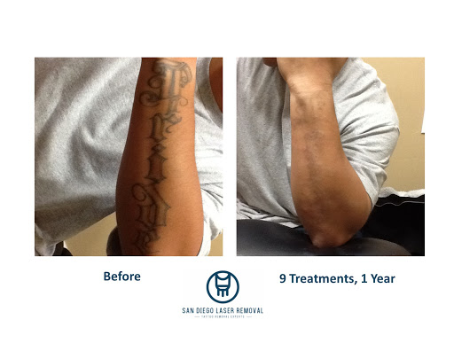 Explore loss tattoo ideas, creative tattoo ideas in San Diego, available at Removery Tattoo Removal & Fading