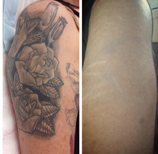 Explore mom and daughter tattoos ideas, creative tattoo ideas in Middle Village, available at Bye Bye Ink Laser Tattoo Removal