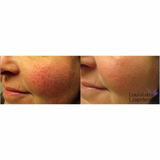 Explore small harry potter tattoo ideas, creative tattoo ideas in Baton Rouge, available at Louisiana Laserderm