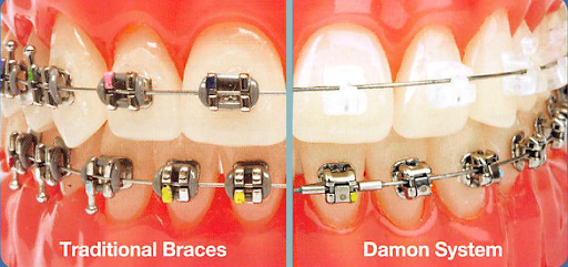 Periodoncista de implantes dentales Aguascalientes