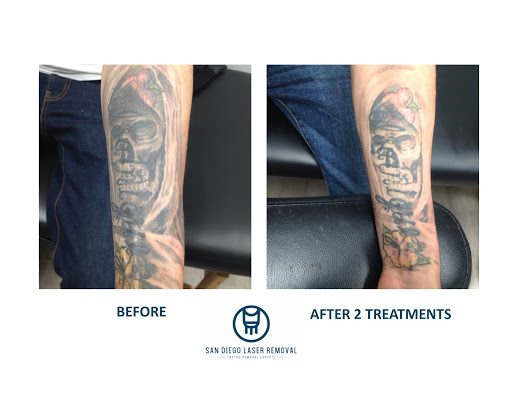 Explore ireland tattoo ideas, creative tattoo ideas in San Diego, available at Removery Tattoo Removal & Fading