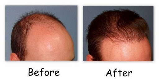 Hair Replacement Service «Hair Restoration Center of Utah», reviews and photos, 2104 Fort Union Blvd, Salt Lake City, UT 84121, USA