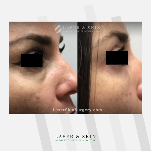 Explore hurricane tattoo ideas, creative tattoo ideas in Southampton, available at Laser & Skin Surgery Center of New York - Southampton