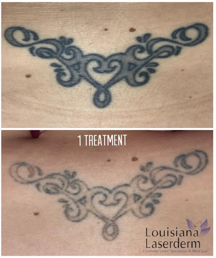 Explore bicep tattoo ideas for guys, creative tattoo ideas in Baton Rouge, available at Louisiana Laserderm