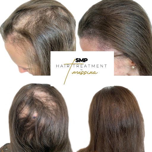 SMP Hair Treatment by T. Messina (Scalp Micropigmentation)