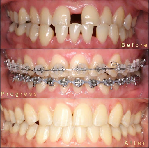Ramaswamy Smile Orthodontics - Braces, Invisalign Orthodontist image 8