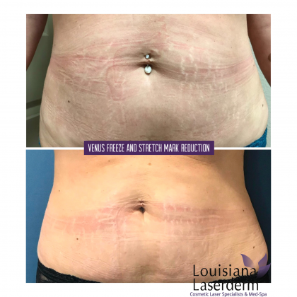 Explore female lion tattoo ideas, creative tattoo ideas in Baton Rouge, available at Louisiana Laserderm