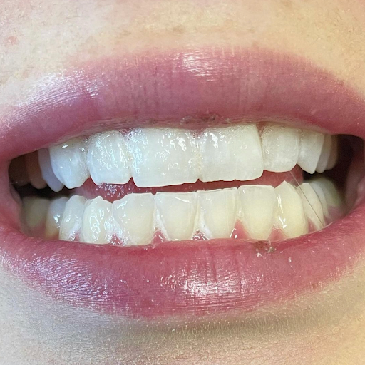 Luma Teeth Whitening
