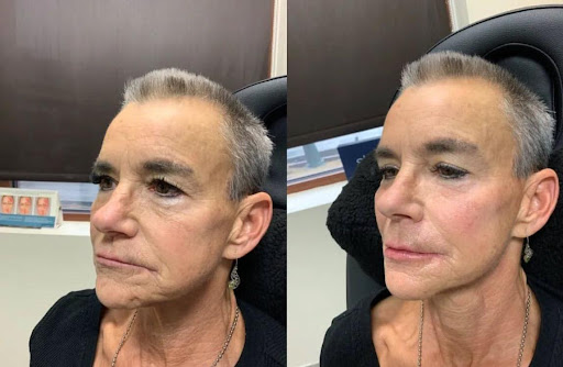 Explore silver lining tattoo ideas, creative tattoo ideas in Boise, available at Spa 35 Med Spa