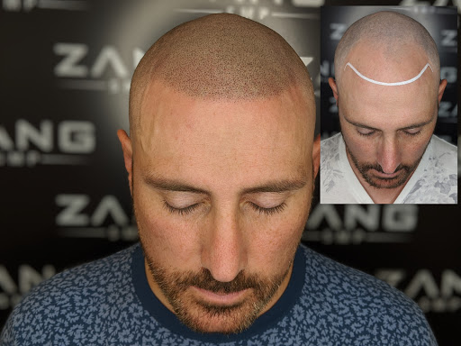 Zang SMP - Scalp Micropigmentation Los Angeles