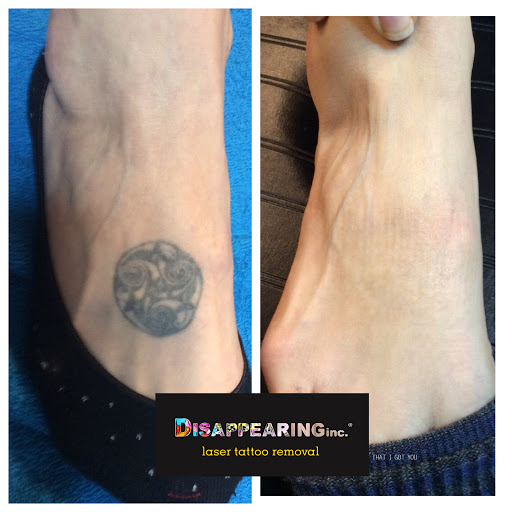 Explore abortion tattoos ideas, creative tattoo ideas in Northampton, available at Removery Tattoo Removal & Fading